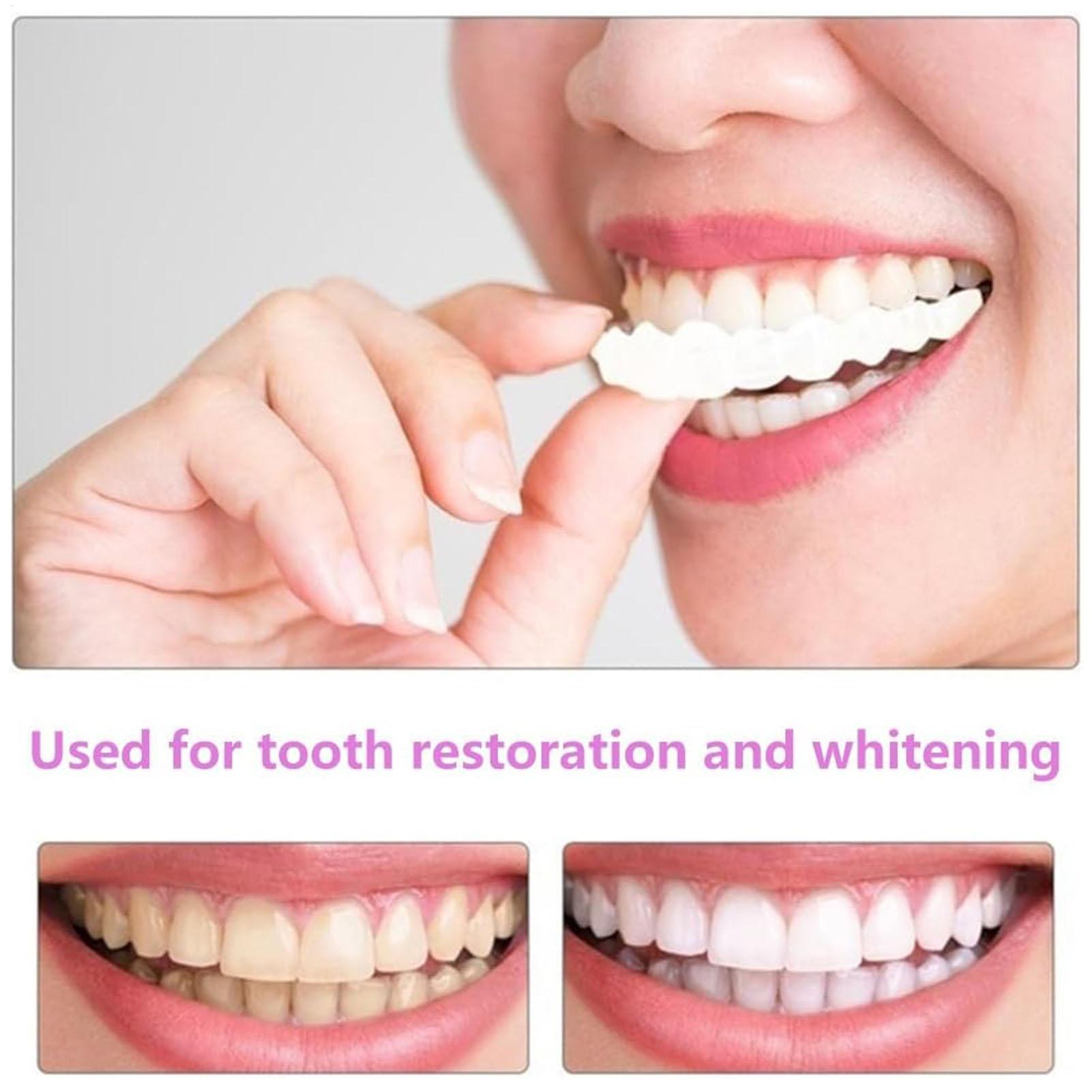 Capa Dentária Superior e Infer - Teeth Whitening Veneers avaliação e preço
