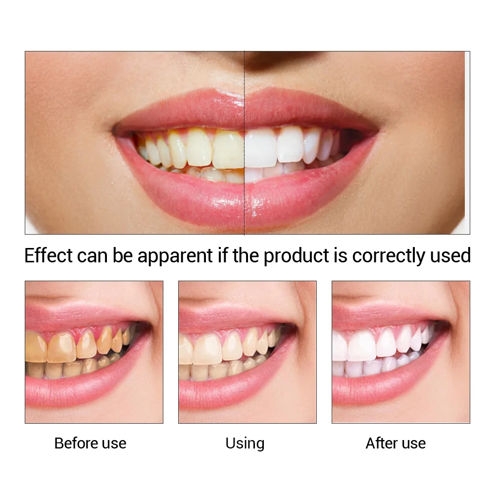 FTEENPLY Essência para claream - Teeth Whitening (Bleaching) avaliação e preço