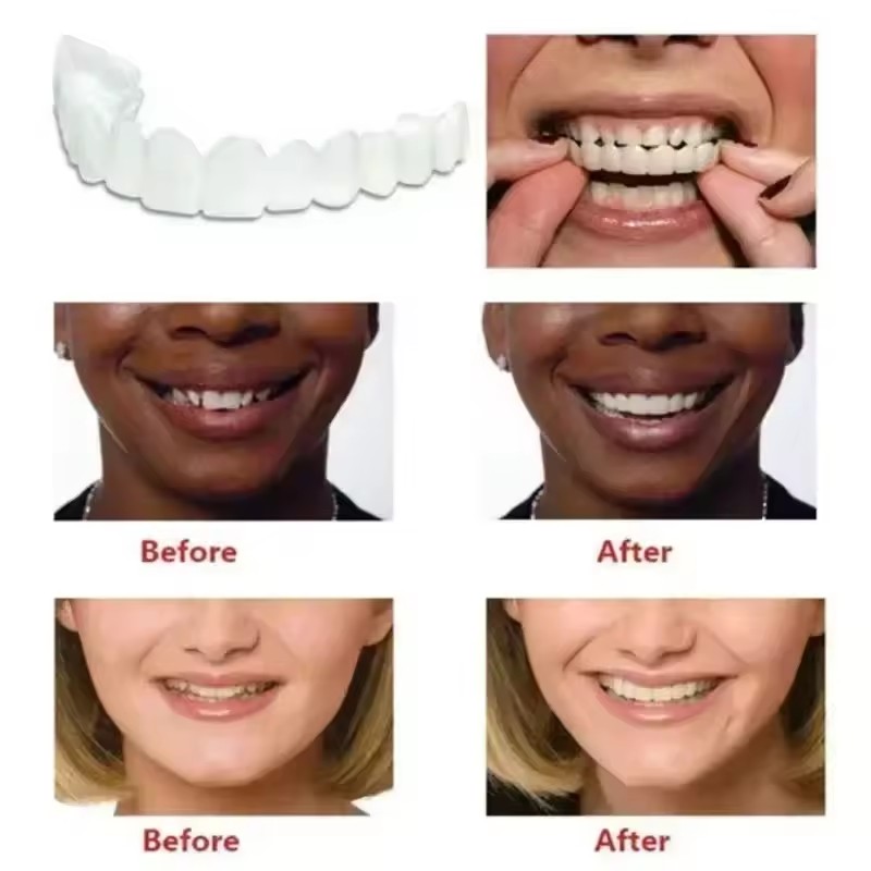 Veneers Dentários para Claream - Teeth Whitening Veneers avaliação e preço
