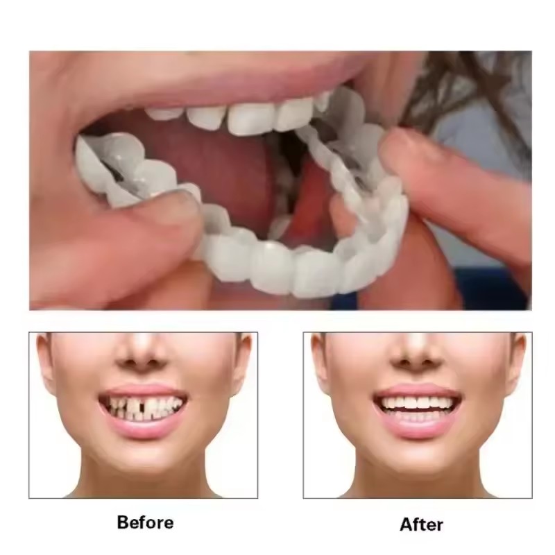 Veneers Dentários para Claream - Teeth Whitening Veneers avaliação e preço
