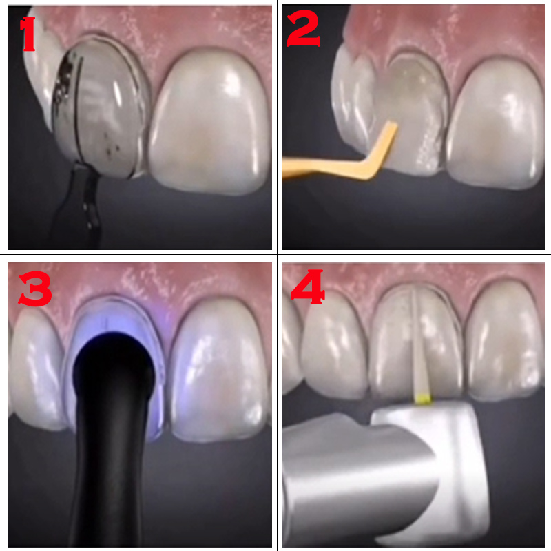 Molde Odontológico para Resina - Teeth Whitening Veneers avaliação e preço