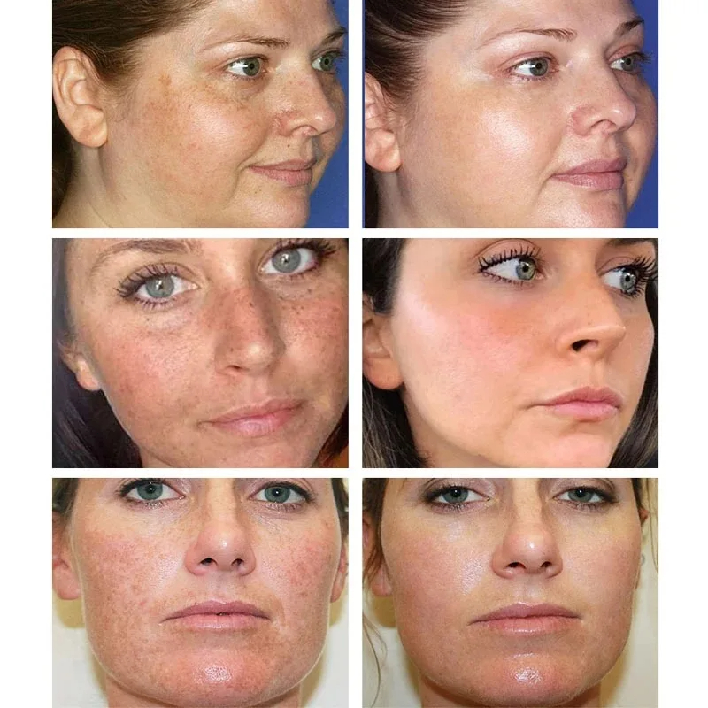 Clareamento creme de sardas re - Charcoal Whitening Paste avaliação e preço