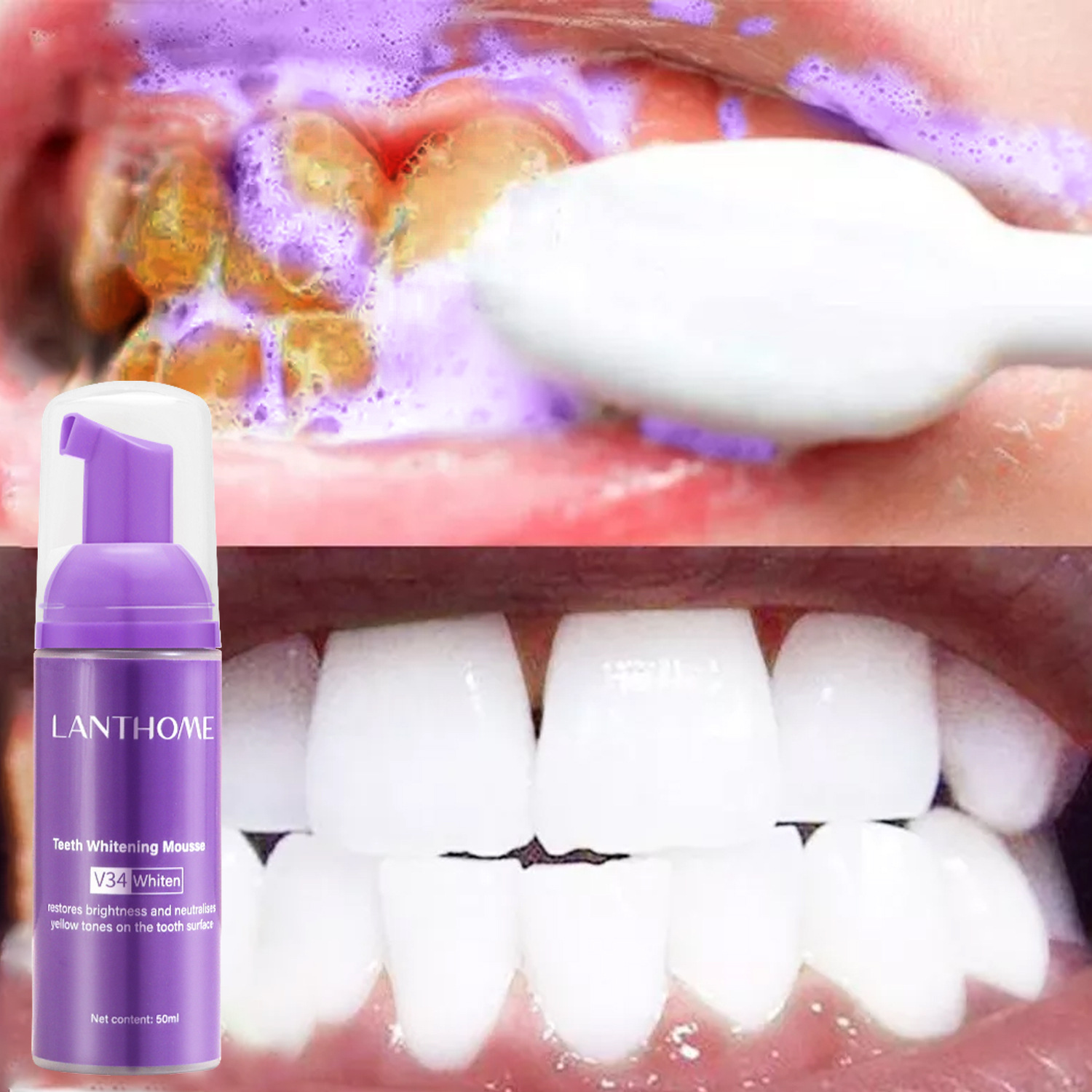 V34 dentes branqueamento mouss - Teeth Whitening (Bleaching) avaliação e preço