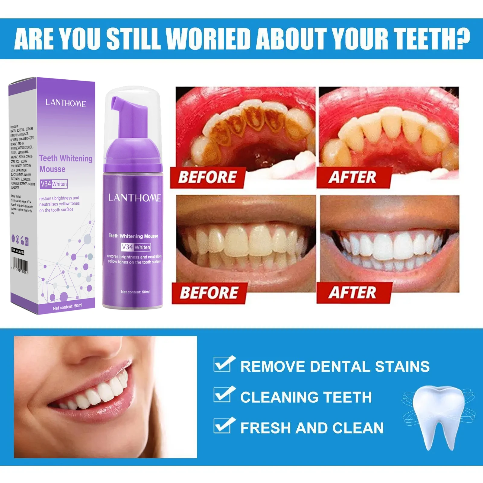 V34 dentes branqueamento mouss - Teeth Whitening (Bleaching) avaliação e preço