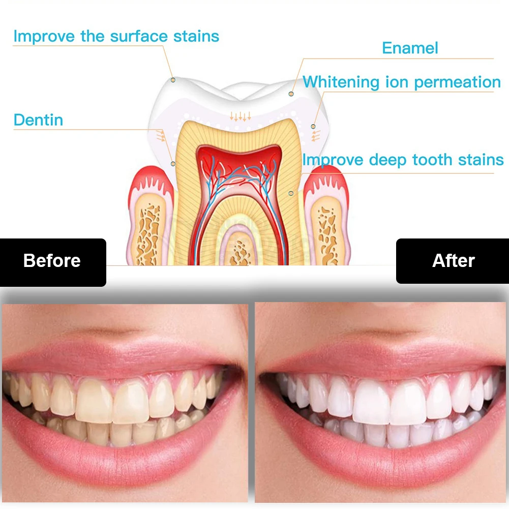 Kit de clareamento dental dos  - Teeth Whitening Foam avaliação e preço
