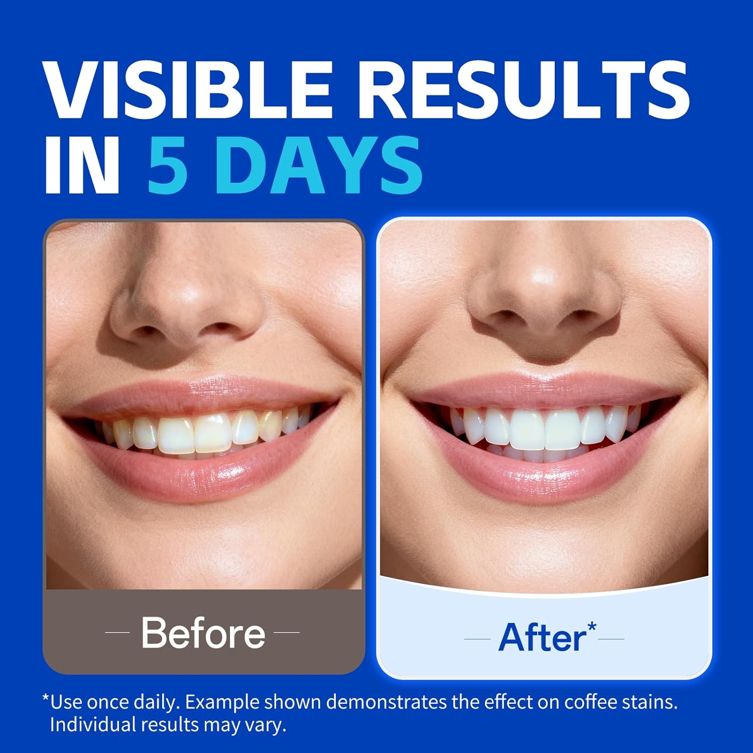 Tiras de Clareamento Dental KH - Teeth Whitening Oil Pulling avaliação e preço
